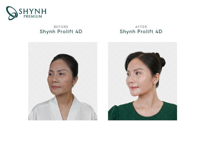 Thay đổi của khách hàng Shynh Premium sau liệu trình Shynh Prolift 4D