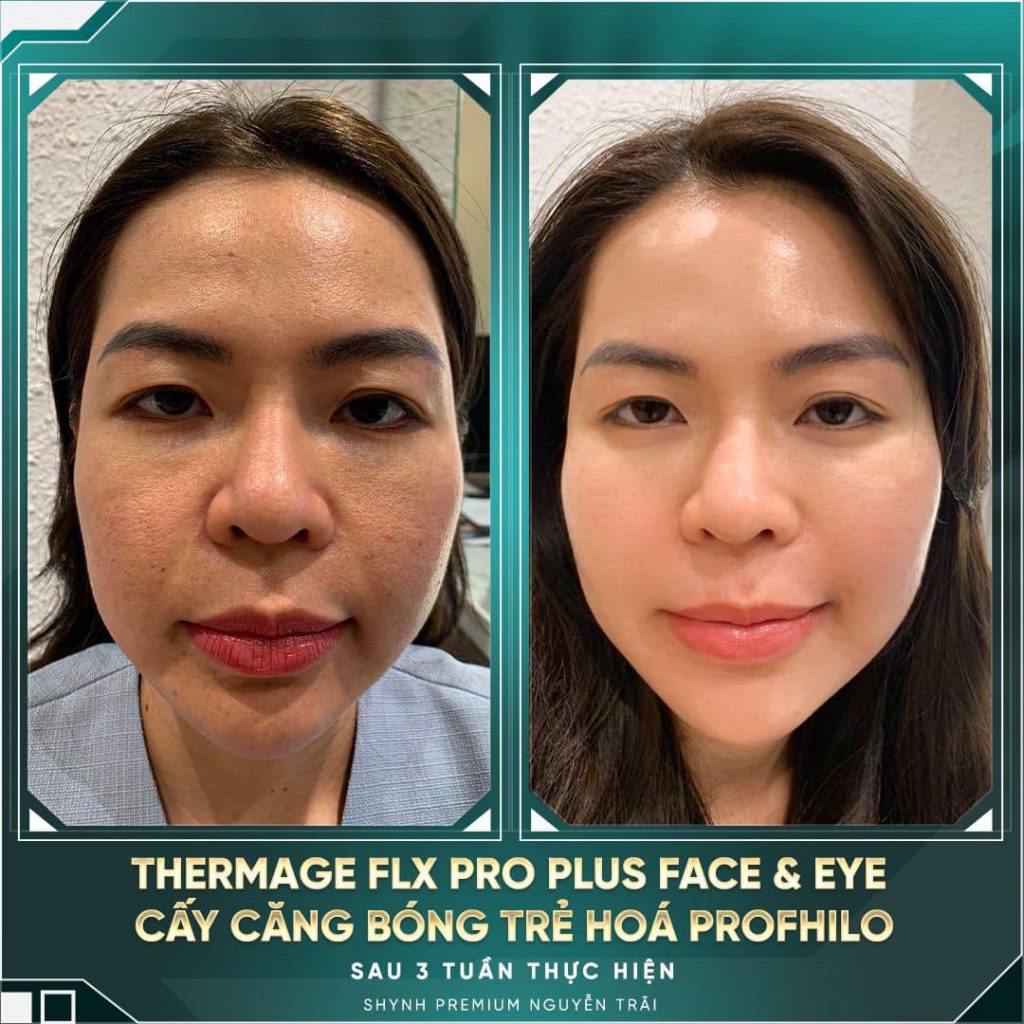 Gương mặt tươi trẻ hơn nhờ sử dụng công nghệ Thermage FLX Pro Plus
