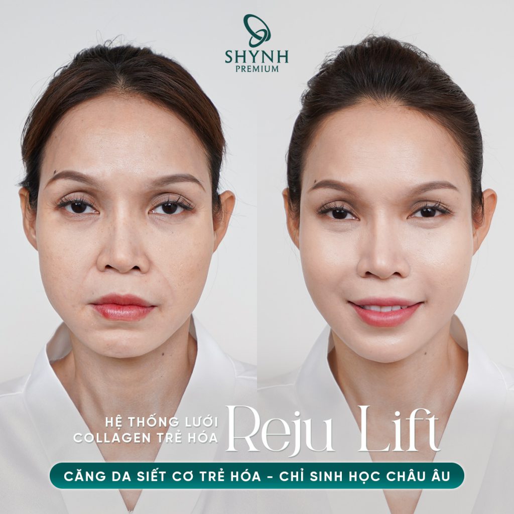 Căng chỉ Reju Lift mang lại liệu quả nâng cơ vùng mắt đỉnh cao