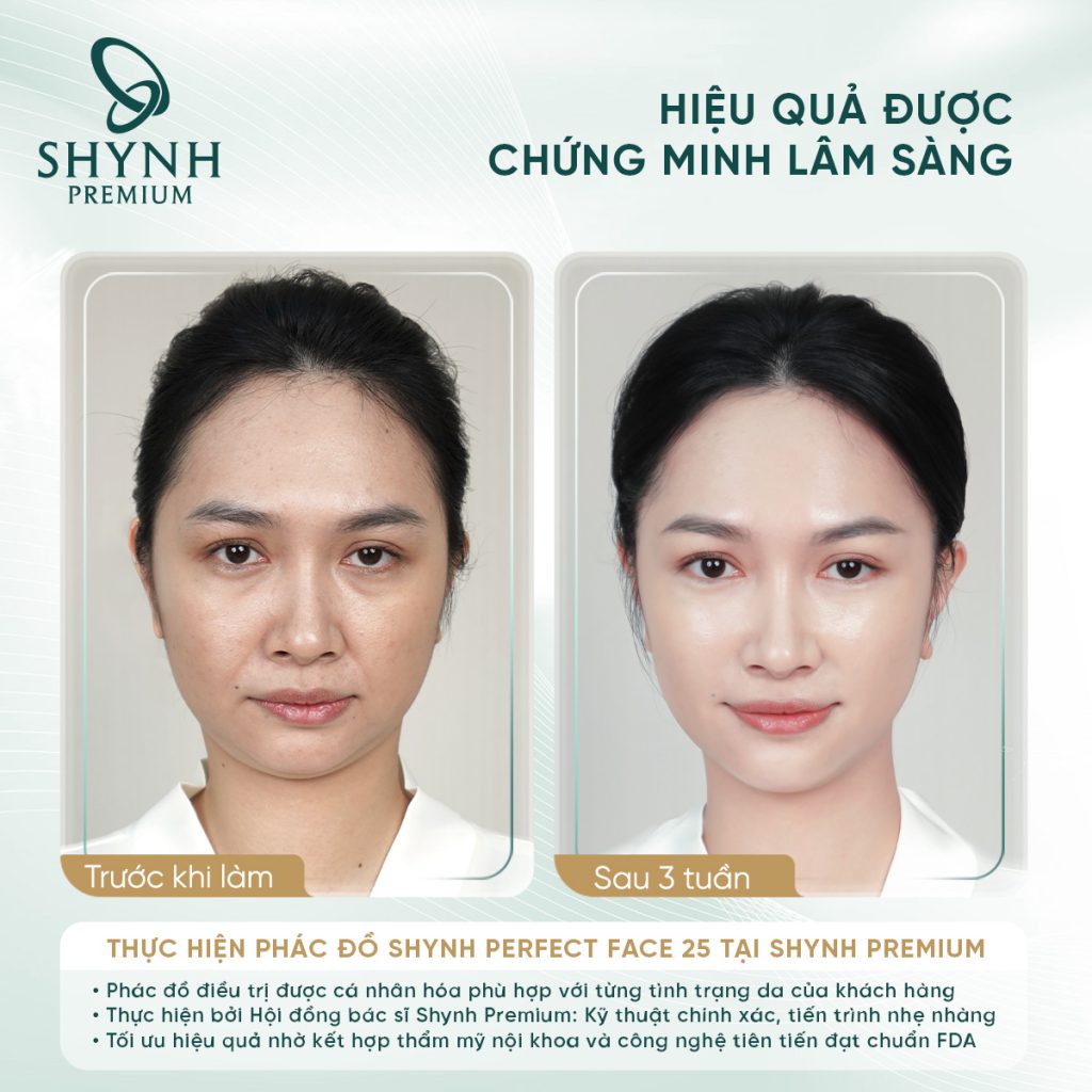 Hình ảnh khách hàng sau phác đồ Shynh Perfect Face 26 của Shynh Premium