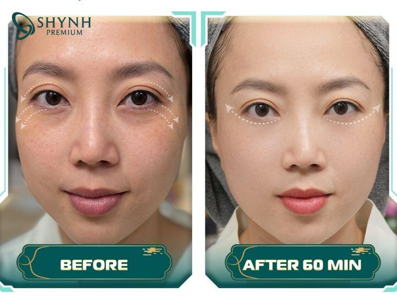 Hiệu quả thực tế từ khách hàng của Shynh Premium được điều trị bằng Thermage FLX