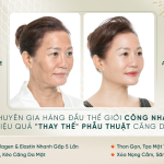 Hình ảnh khách hàng điều trị Therapy vùng mặt tại Shynh Premium