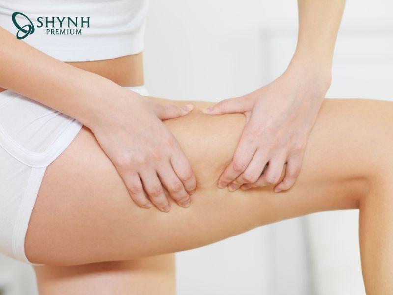 Mỡ đùi tích tụ là kết quả của nhiều yếu tố tác động
