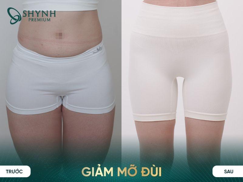 Phác đồ Slim Fit Promax AI được ưa chuộng nhờ hiệu quả cá nhân hóa đến từng cơ địa