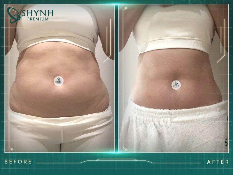Thay đổi của khách hàng Shynh Premium sau liệu tình Cooltech Define Pro Plus