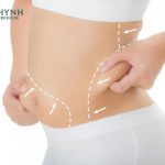 Hút mỡ cần 6 tháng để cơ thể định hình hoàn toàn như mong muốn