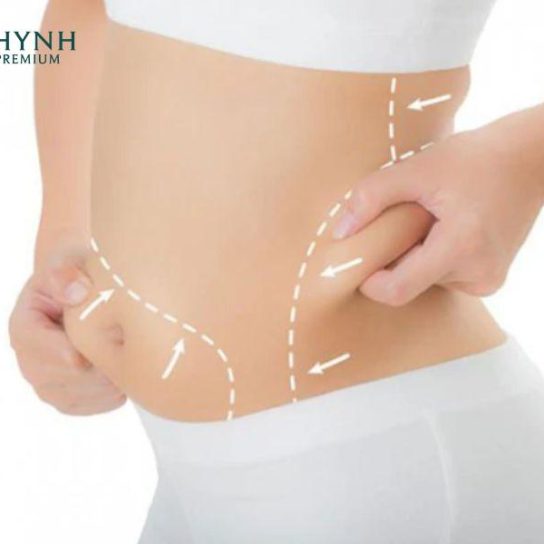 Hút mỡ cần 6 tháng để cơ thể định hình hoàn toàn như mong muốn