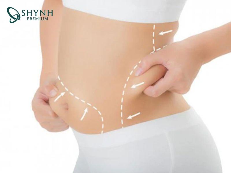 Hút mỡ cần 6 tháng để cơ thể định hình hoàn toàn như mong muốn