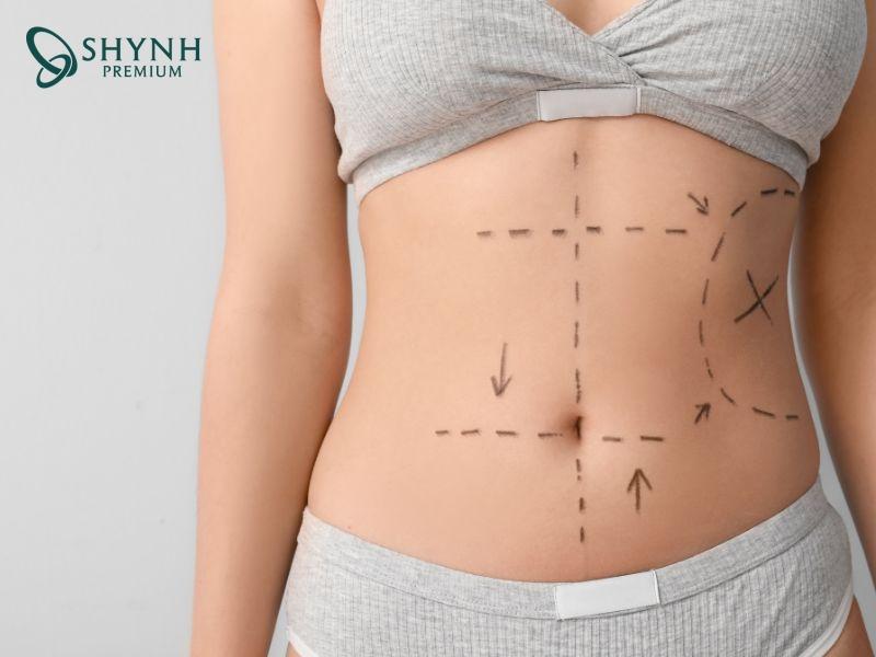 Hút mỡ bụng sử dụng ống hút chuyên dụng để cải thiện đường nét vóc dáng