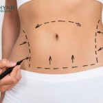Hút mỡ có thể sẽ đau sau khi thuốc mê hết tác dụng