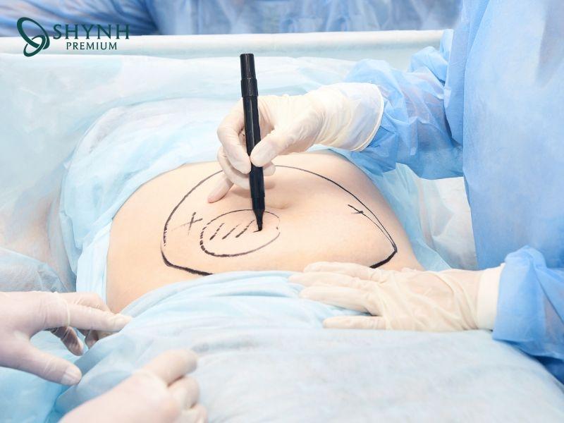 Hút mỡ bụng giúp loại bỏ phần mỡ thừa lâu năm