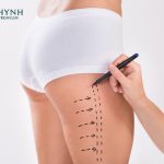 Trước khi hút mỡ, bác sĩ sẽ khám và xem xét kỹ lưỡng vùng mỡ cần hút