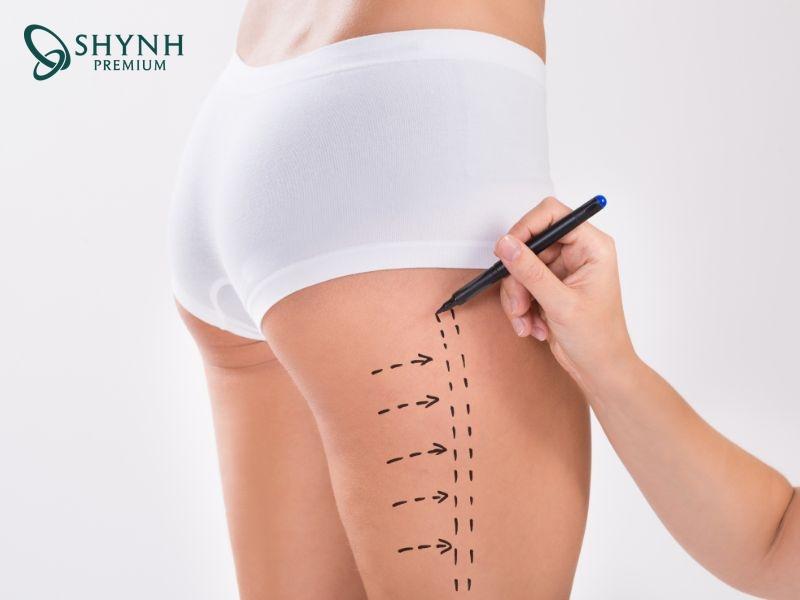 Trước khi hút mỡ, bác sĩ sẽ khám và xem xét kỹ lưỡng vùng mỡ cần hút