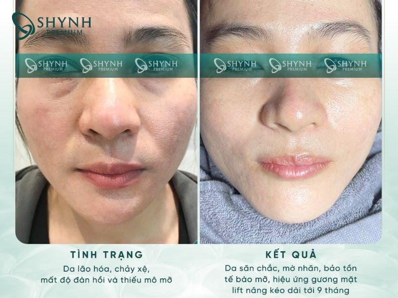 Liệu trình nâng cơ tại Shynh Premium mang lại thay đổi rõ rệt trên gương mặt khách hàng