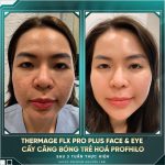 nâng cơ rf giúp trẻ hoá da