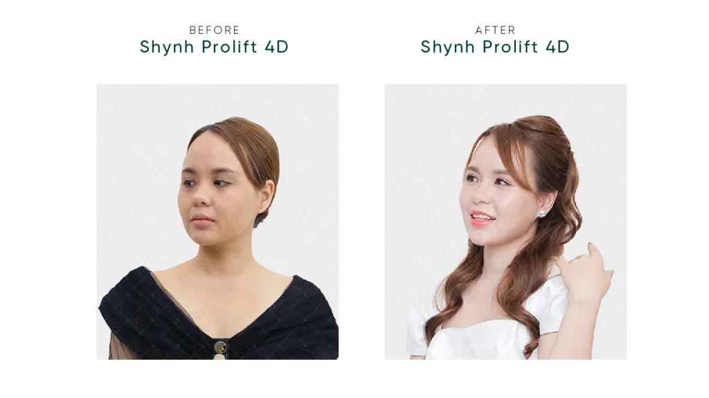 Hình ảnh thay đổi của khách hàng Shynh Premium sau liệu trình Shynh Prolift 4D