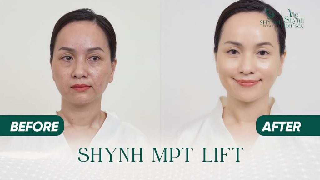 Liệu trình Shynh MPT Lift đem lại hiệu quả nâng cơ mắt cho khách hàng Shynh Premium