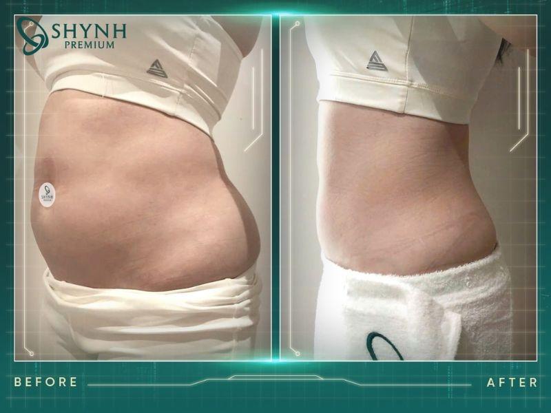 Hình ảnh before - after của khách hàng Shynh Premium