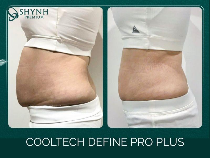 Liệu trình Cooltech Define Pro Plus giúp khách hàng giảm mỡ vòng bụng nhanh chóng