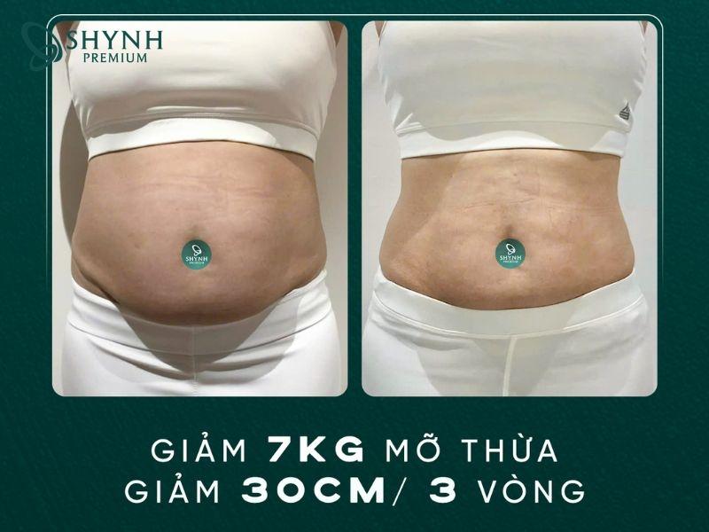 Hình ảnh trước và sau khi khách hàng dùng liệu trình giảm mỡ của Shynh Premium