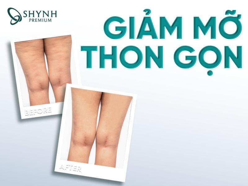 Thay đổi của khách hàng Shynh Premium sau liệu trình giảm mỡ tại Shynh Premium