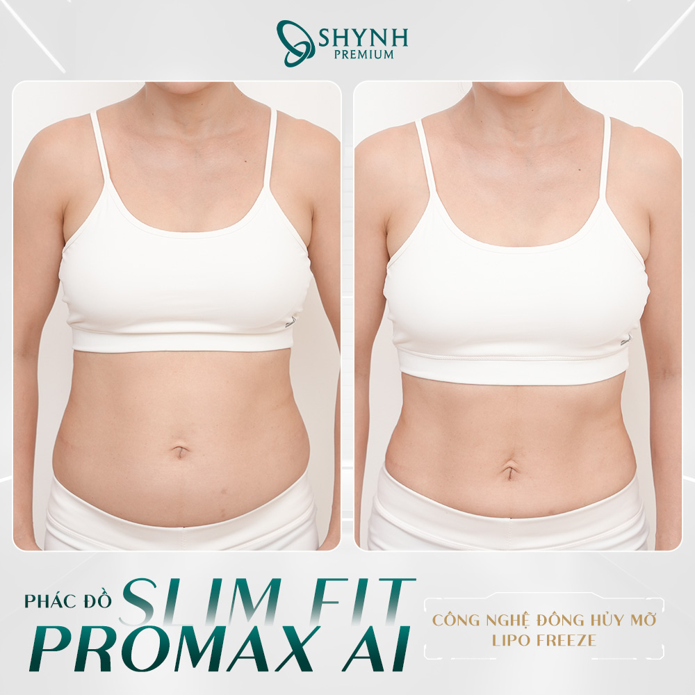 Phác đồ Slim Fit Promax AI giúp khách hàng giảm mỡ rõ rệt chỉ sau 1 lần điều trị