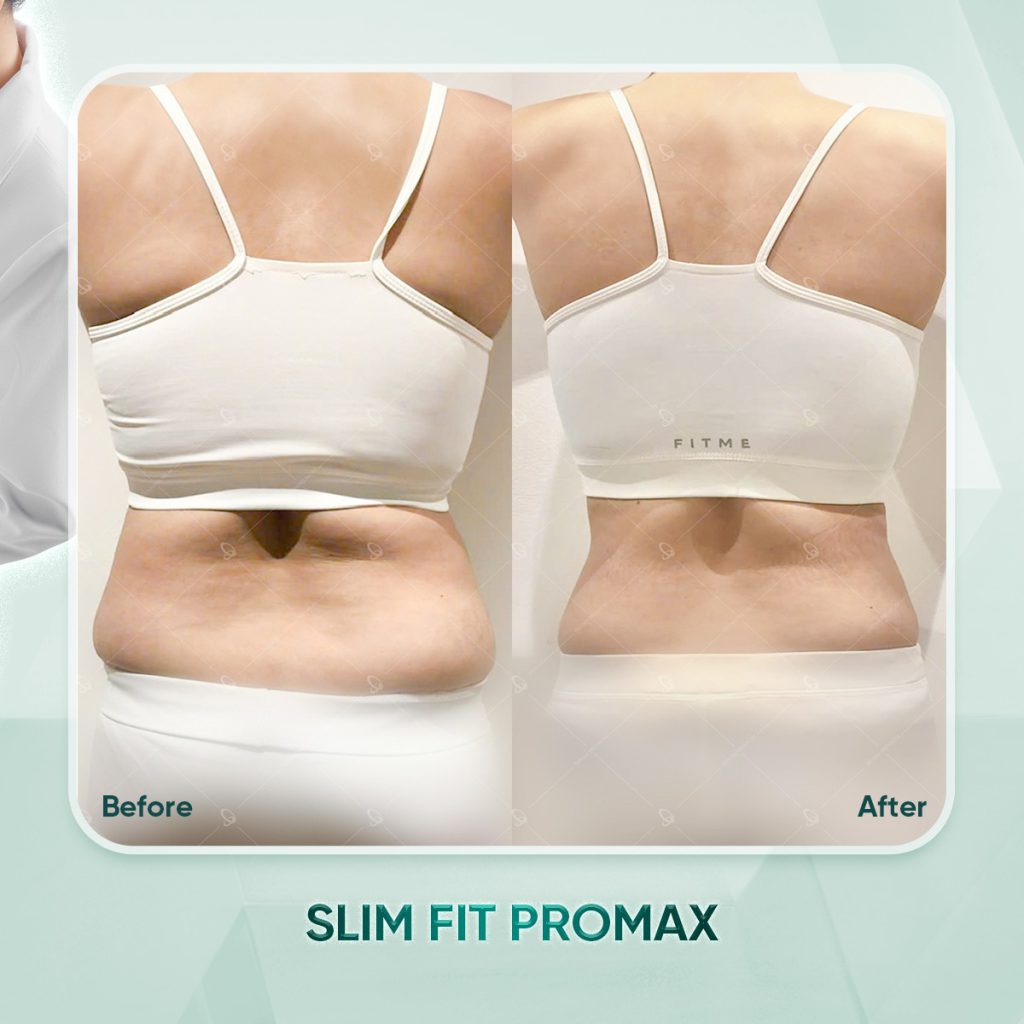 Phác đồ của Shynh Premium làm thay đổi vùng lưng của khách hàng rõ rệt