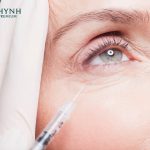 Botox làm mờ nếp nhăn chân chim ở đuôi mắt thường lộ rõ khi cười