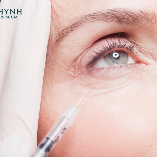 Botox làm mờ nếp nhăn chân chim ở đuôi mắt thường lộ rõ khi cười
