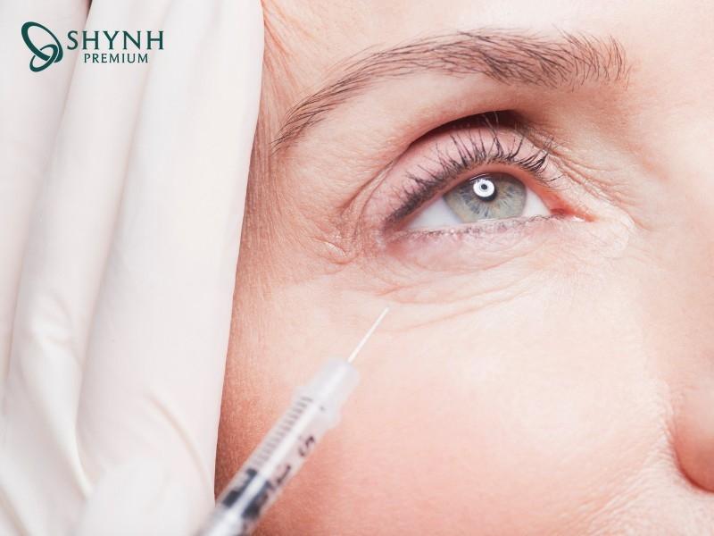 Botox làm mờ nếp nhăn chân chim ở đuôi mắt thường lộ rõ khi cười