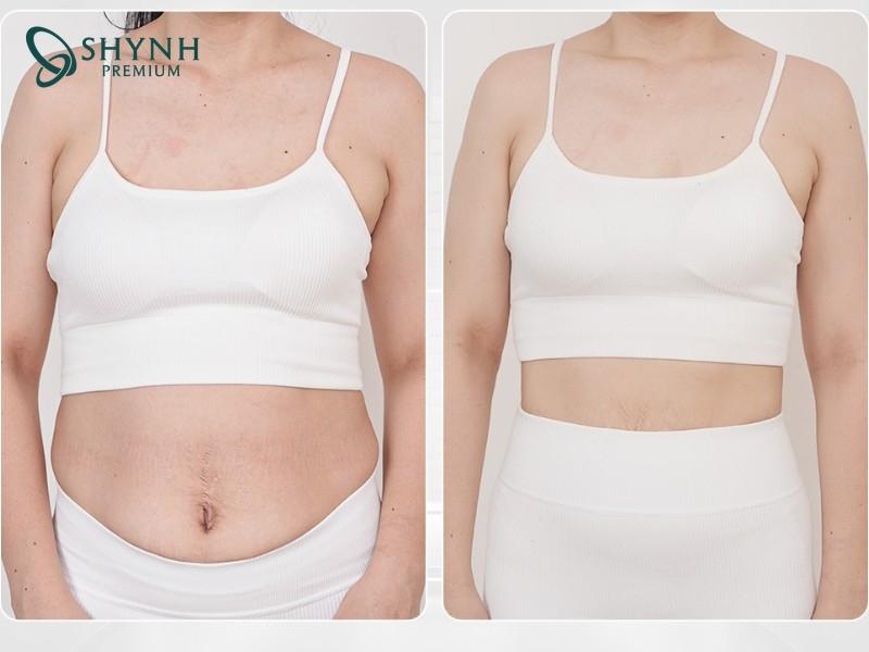 Hình ảnh trước và sau khi khách hàng dùng phác đồ giảm mỡ của Shynh Premium