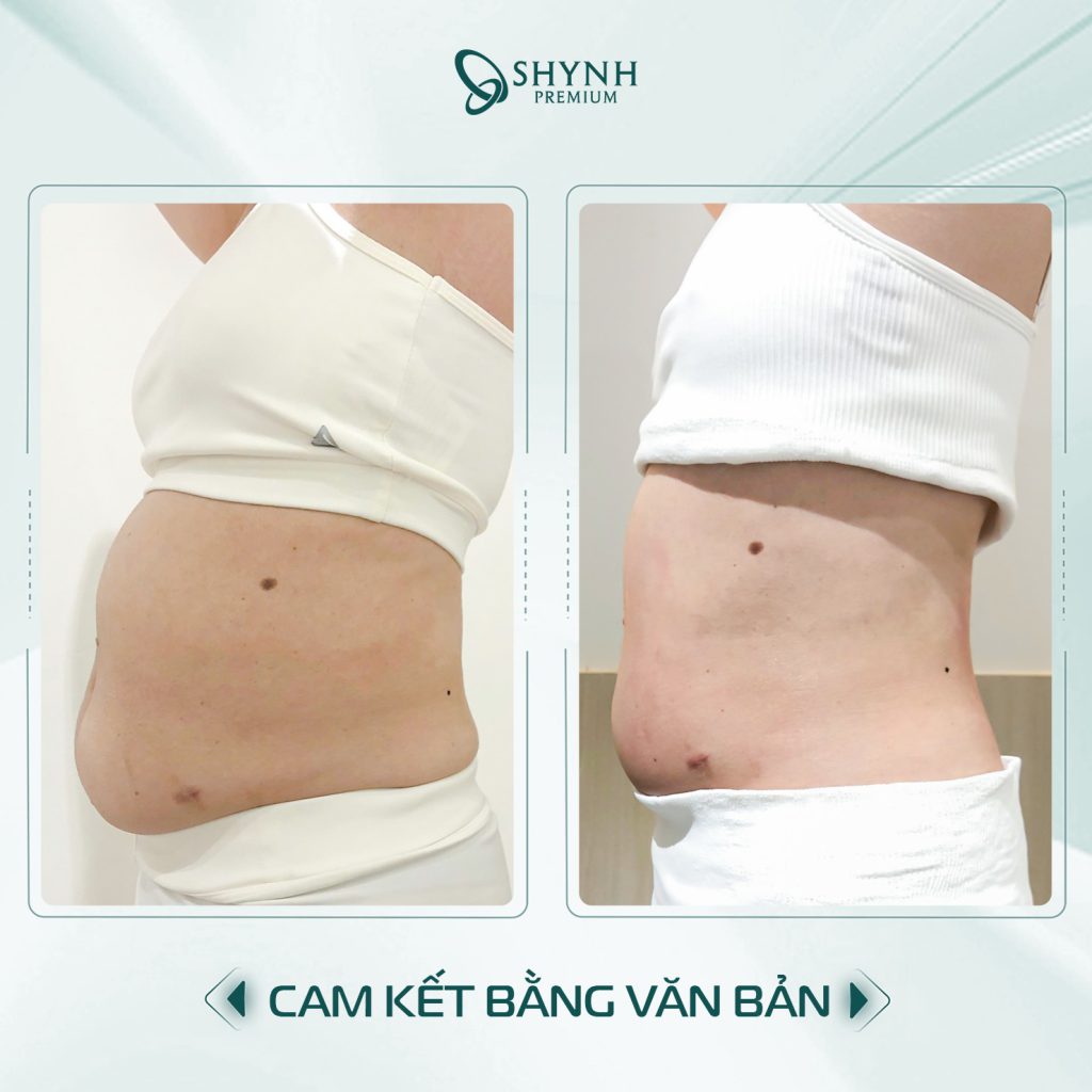 Hình ảnh thay đổi của khách hàng sau liệu trình của Shynh Premium