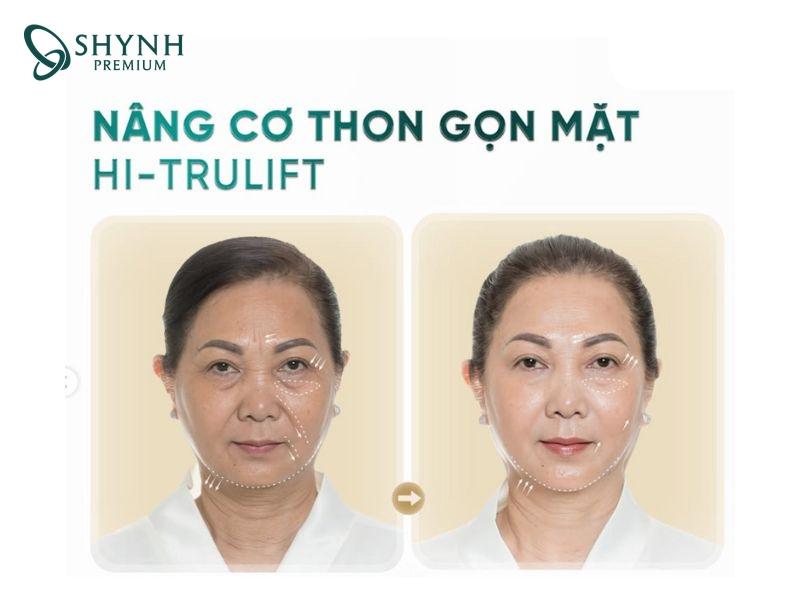 Sự thay đổi rõ rệt của khách hàng Shynh Premium sau khi nâng cơ Hi-Trulift