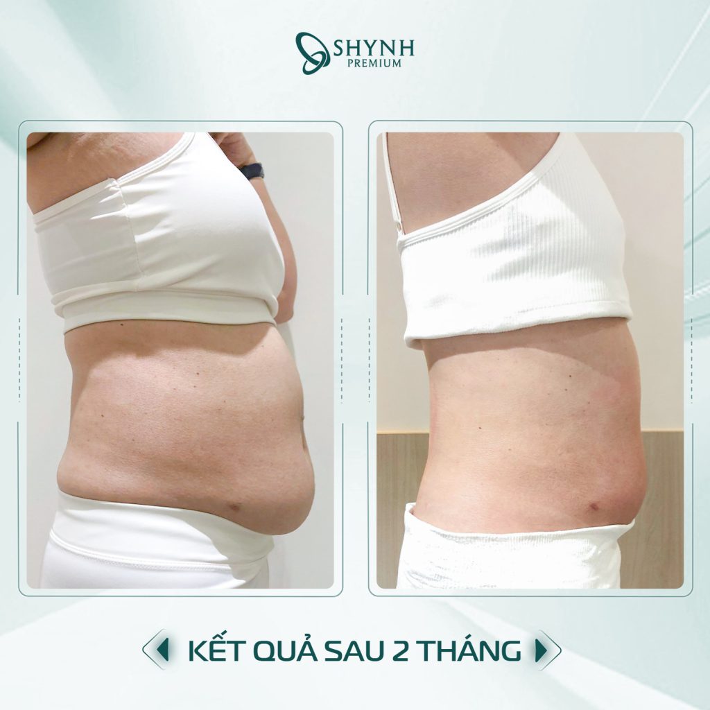 Sự thay đổi của khách hàng Shynh Premium sau phác đồ giảm mỡ