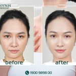 Sự thay đổi của khách hàng khi tiêm botox căng da mặt tại Shynh Premium