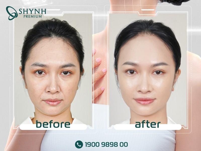Sự thay đổi của khách hàng khi tiêm botox căng da mặt tại Shynh Premium