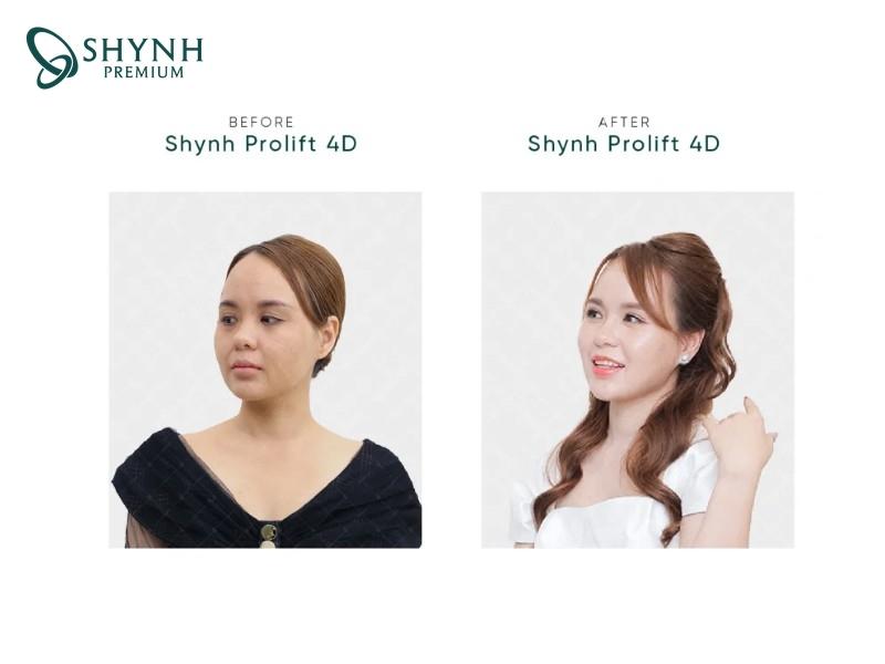 Hình ảnh thay đổi của khách hàng sau liệu trình tại Shynh Premium