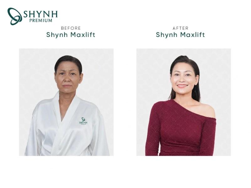Hình ảnh thay đổi của khách hàng Shynh Premium sau liệu trình Shynh Maxlift