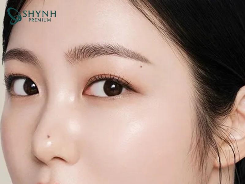 Căng da thái dương mang lại gương mặt trẻ trung, tươi tắn