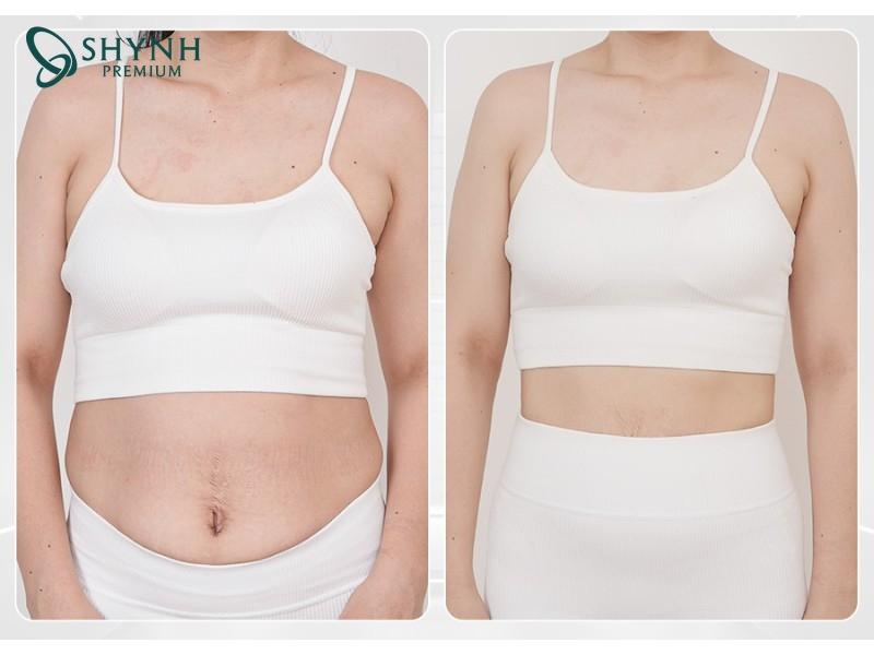 Phác đồ tại Shynh Premium đem lại hiệu quả giảm cân rõ rệt và tự nhiên cho khách hàng