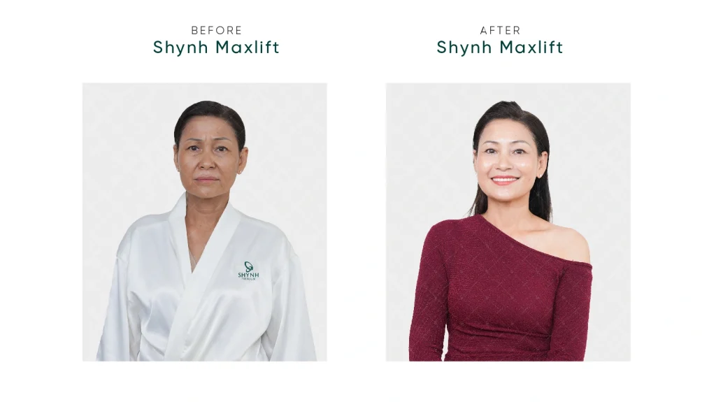 Căng chỉ collagen giúp cải thiện nếp nhăn ấn đường hiệu quả, được khách hàng ưa chuộng tại Shynh Premium