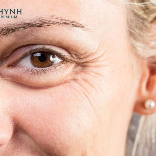 Nếp nhăn vùng mắt do yếu tố bên trong cơ thể và tác động từ môi trường