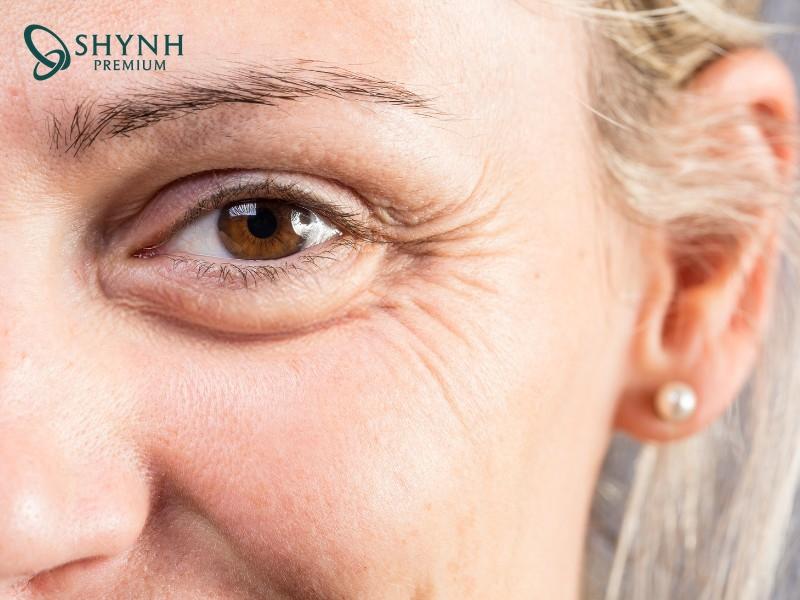 Nếp nhăn vùng mắt do yếu tố bên trong cơ thể và tác động từ môi trường