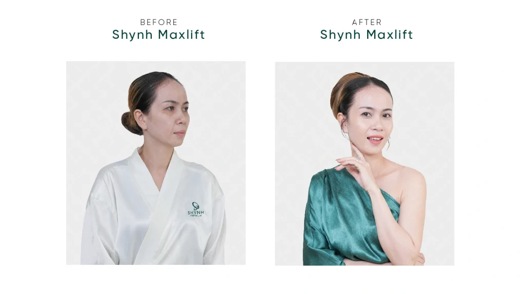 Hình ảnh trước và sau khi khách hàng dùng liệu trình xoá nhăn tại Shynh Premium