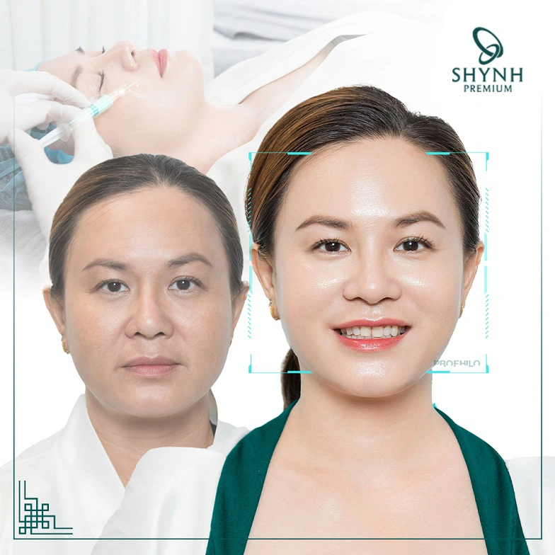 Hình ảnh khách hàng sau liệu trình Profhilo tại Shynh Premium