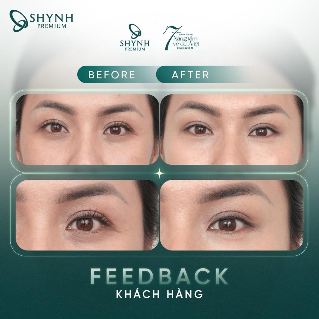 Hình ảnh trước và sau khi khách hàng sử dụng liệu trình căng da mắt tại Shynh Premium