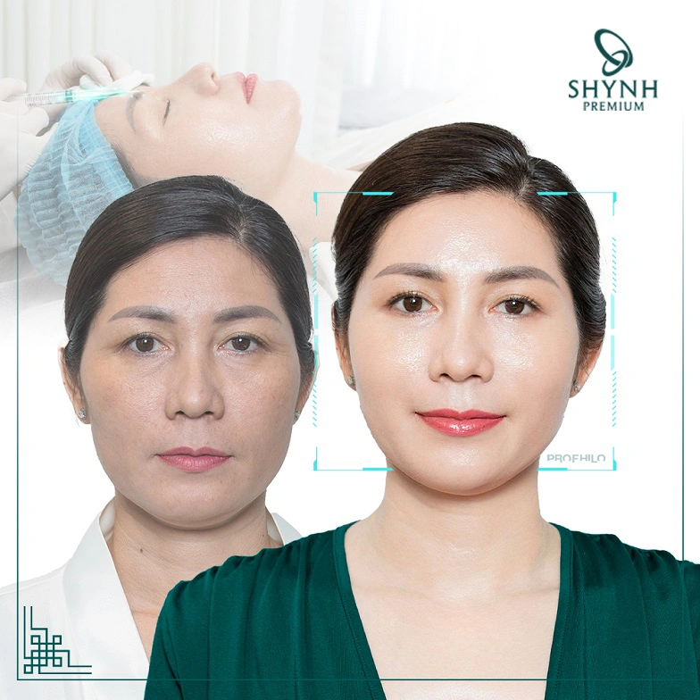Liệu trình Profhilo của Shynh Premium mang lại làn da căng bóng và tươi trẻ