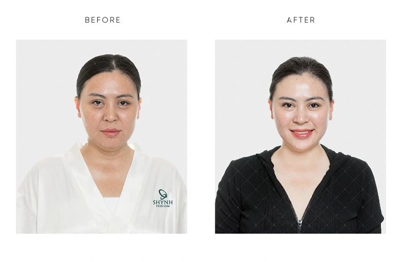 Hình ảnh trước và sau khi khách hàng dùng liệu trình căng bóng da tại Shynh Premium
