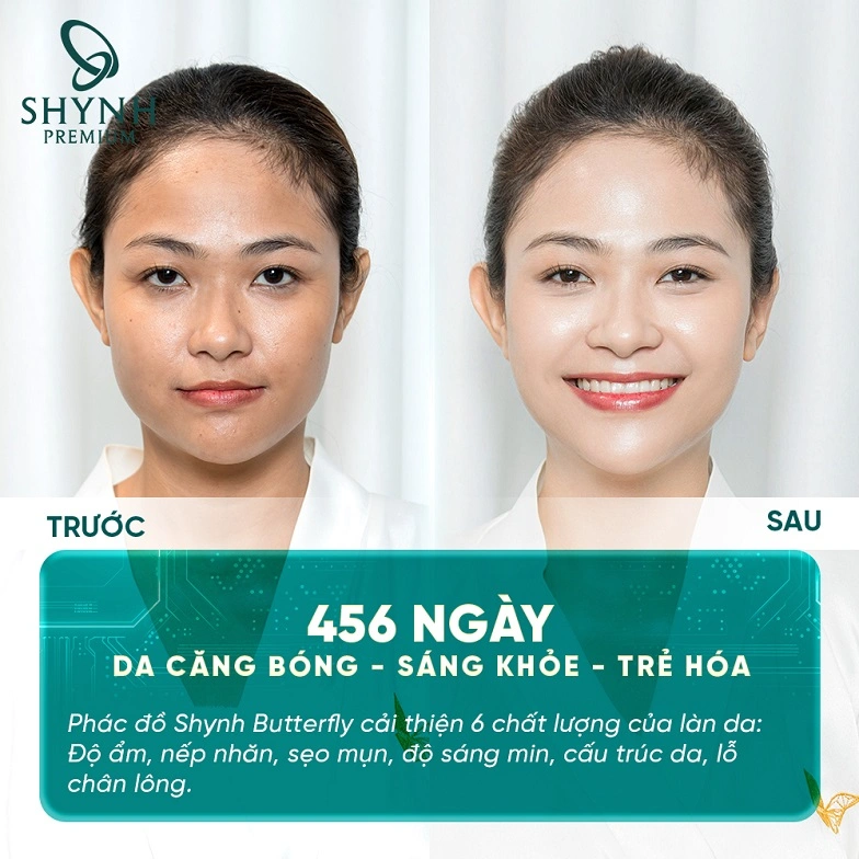 Hình ảnh khách hàng Shynh Premium trước và sau khi cấy căng bóng da