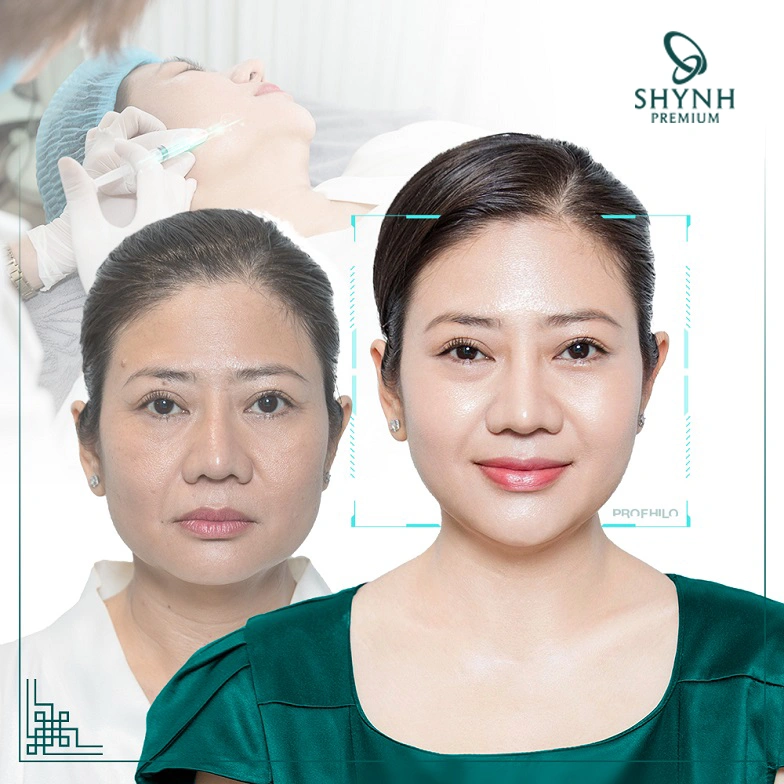 Hình ảnh thay đổi rõ rệt của khách hàng sau liệu trình căng bóng da tại Shynh Premium